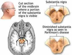 Parkinson&rsquo;s Diseases Surgery India