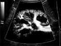 Sample image: Power Doppler ultrasound of the kidney. This image shows the tiny blood vessels in the kidney like the branches of a tree.