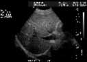 Sample image: Ultrasound of the liver. This image demonstrates the liver tissue. The darker linear areas in the liver are veins bringing blood and nutrients to the liver and others are draining blood from the liver and returning it to the heart.