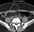 CT scan of a normal appendix in the right lower abdomen. The appendix normally connects with the right colon and contains air- this appears black on the scan. Air in the appendix excludes appendicitis since this means that the appendix is not obstructed or inflamed.