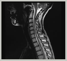 cervical spine surgery India, cost cervical spine surgery India