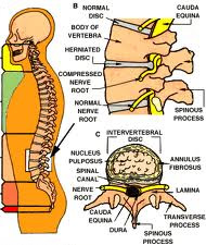 low cost laminectomy surgery, laminectomy low cost India, benefits laminectomy surgery