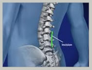lumbar spine surgery India, cost lumbar spine surgery India, low cost lumbar spine surgery India
