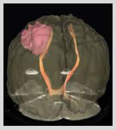 neurosurgery India, cost neurosurgery India