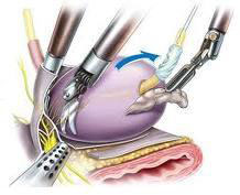 low cost robotic surgery India, benefits robotic surgery India, robotic surgery India