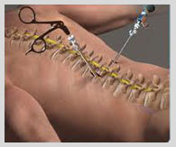 spine surgery India, cost spine surgery India