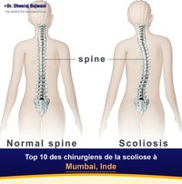 Top 10 des chirurgiens de la scoliose à Mumbai, Inde (2026-2027)