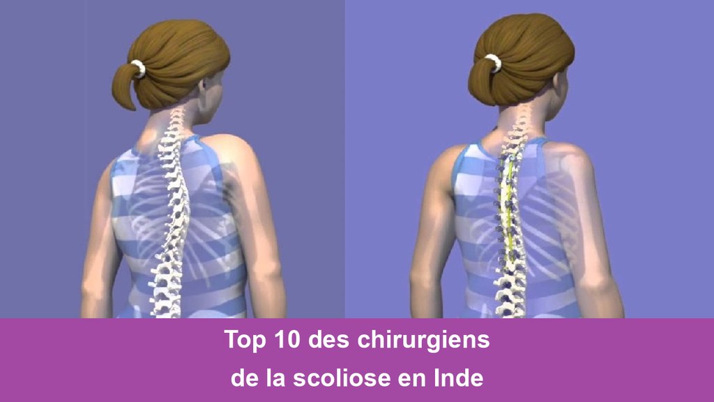 Top Scoliosis Surgeons in India Top 10 des chirurgiens de la scoliose en Inde