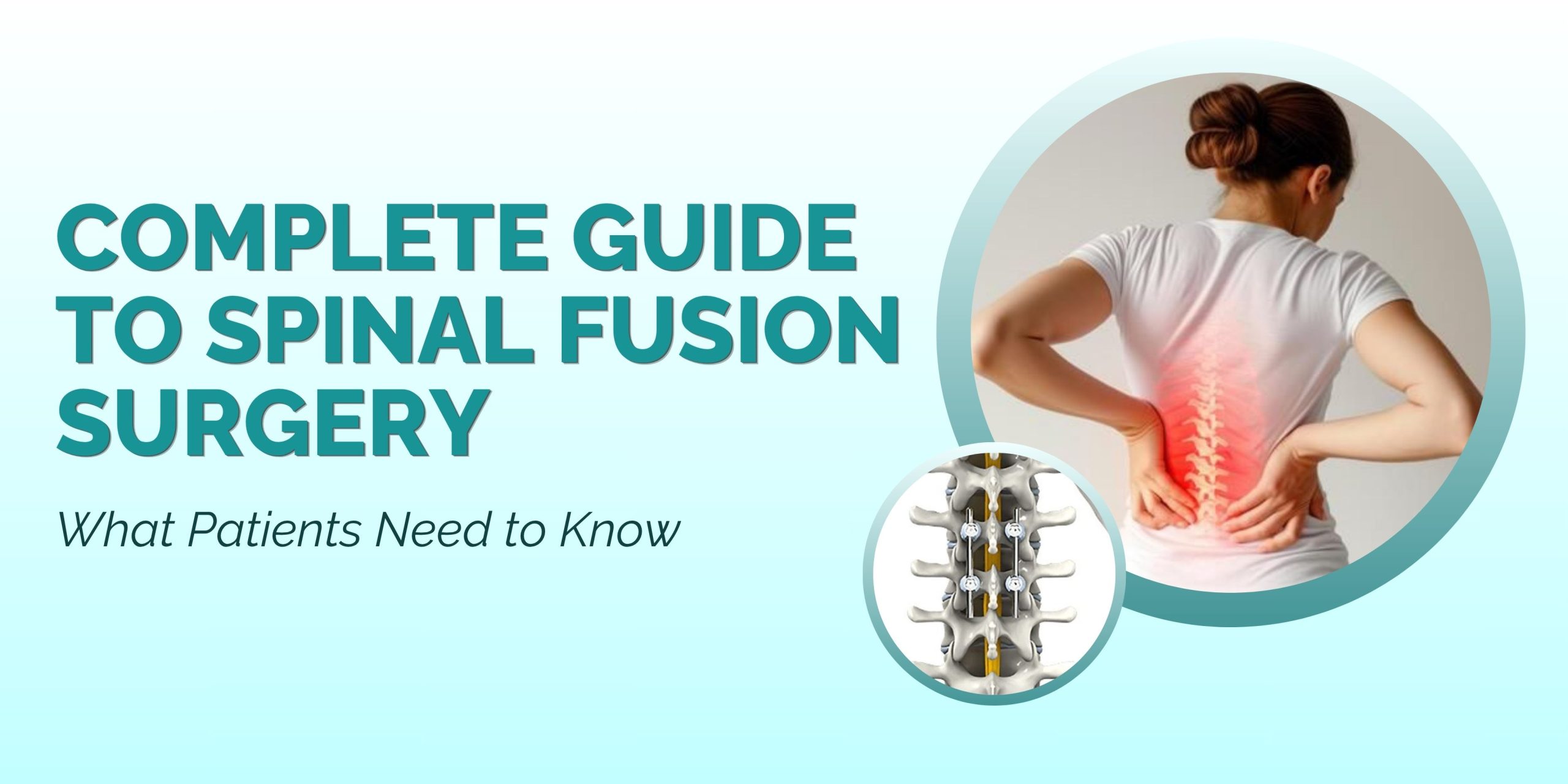 Complete Guide to Spinal Fusion Surgery: What Patients Need to Know