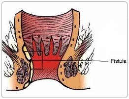 Anal Fistula Surgery in India