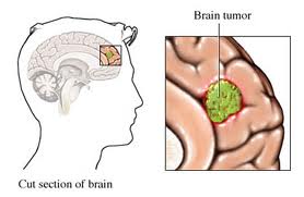 Low Cost Meningioma Surgery India