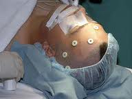 Meningioma Surgery Benefits India
