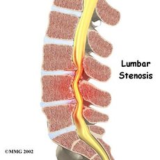Lumbar Canal Stenosis Surgery in India