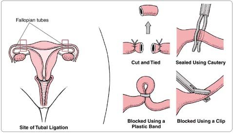 Sterilization Surgery in India