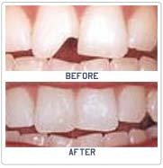 Tooth Contouring and Reshaping Surgery in India