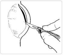 Abscess Perianal Surgery in India