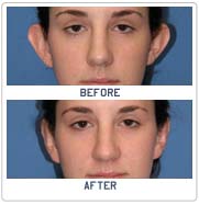 Ear Surgery in India