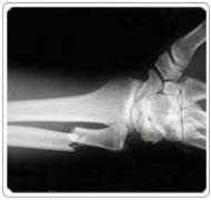 Radius and Ulna Fracture - Internal Fixation  Surgery  India