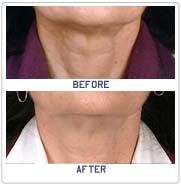 Neck Lift Surgery in India