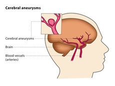 Intracranial Aneurysm Surgery in India