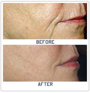 Low Cost Injectable Fillers Delhi India