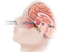Pituitary Gland Tumor Surgery in India
