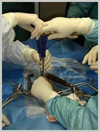 procedure laminectomy surgery