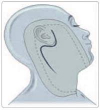 Parotid Gland Removal - Parotidectomy  Surgery India