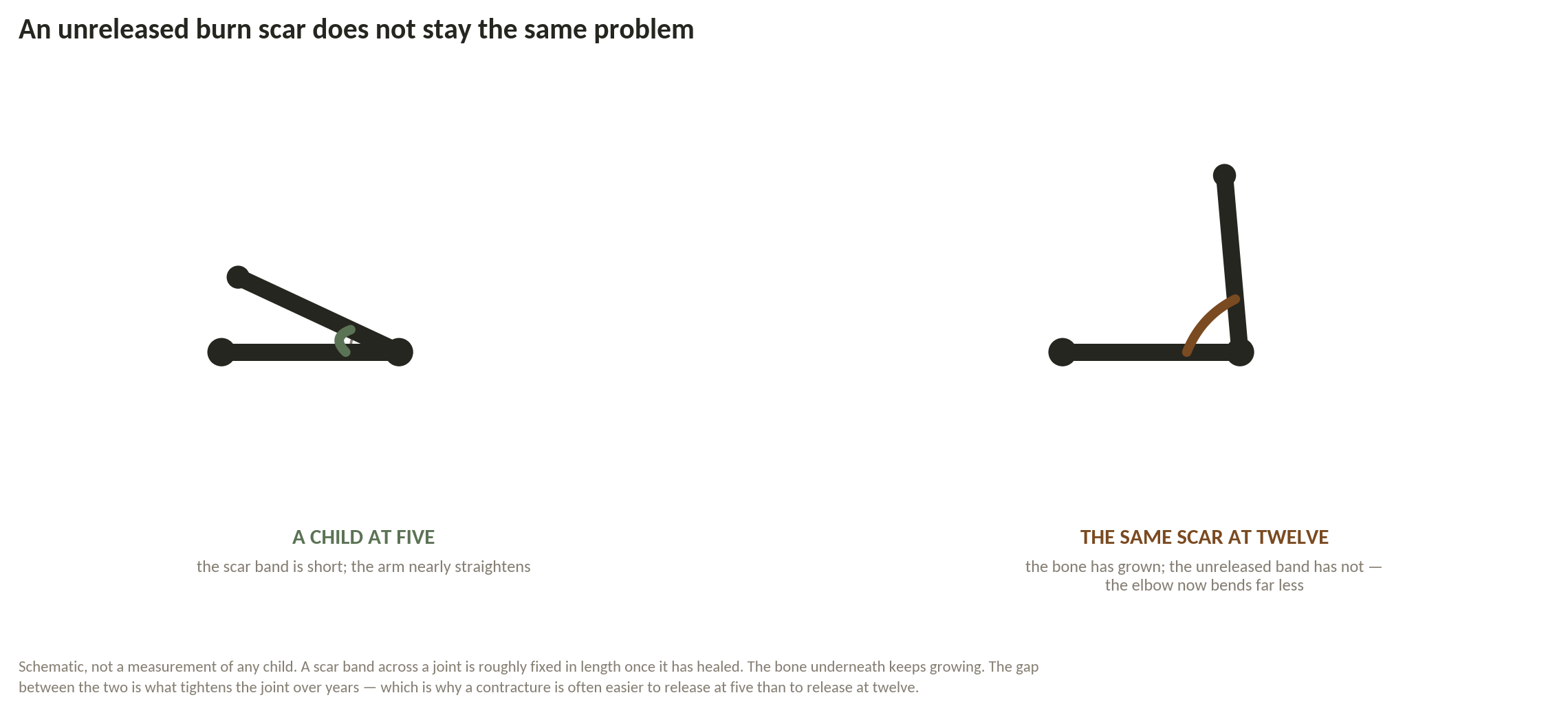 Chart: If it is a child's burn scar, is the clock running?