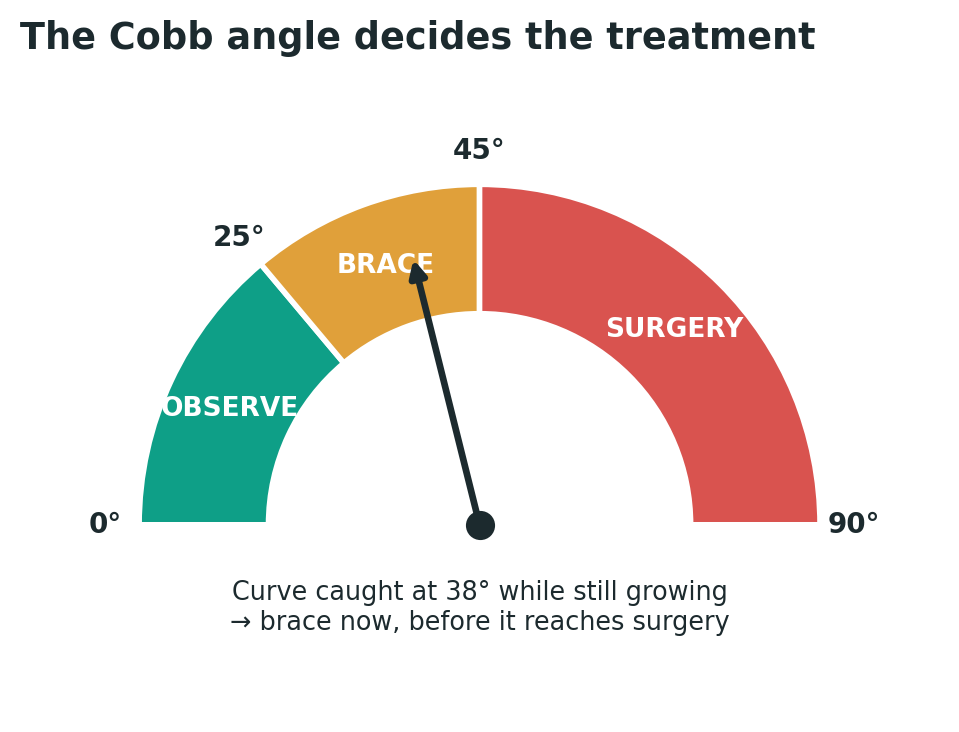 Chart: Knowledge first: the Cobb angle decides the treatment
