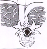 BrainTumour/Cancer, Stereotactic Neuro Surgery, Brain Surgery, Pituitary Tumours, Surface Tumours, Cerebellopentive angle tumours, Foramen Magnum Tumours, Cerebro Vascular Surgery, Neuro Cosmetic Sugery, Facial Pain Disc-prolapsc, Back Pain, Neck Pain, Lumbar spondylolisthesis, Low Back Pain, Radiculopathy, TB spine(Tuberclosis), Back ache, neck ache, spinetumours + spinal chord tumours, spinal chord injury, Micro discetomy, endoscopic discetomy, spinal fusion, spinal stafilization, cervical discetomy fusion, Spinal instrumentation, Tumours, Surgery, Neuro Surgery, Cancer, Treatement, Spinal Surgery, Vascular, Discetomy