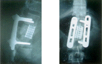 Pedicle screws & plates along with titanium spacer used to 