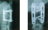 Iliac crest graft & plate